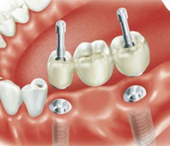Ортопедический стоматологический приём - Стоматологическая клиника "Дента-проф" р.п. Шаля