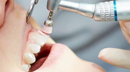 Чистка зубов профессиональными методами - Стоматологическая клиника "Дента-проф" р.п. Шаля