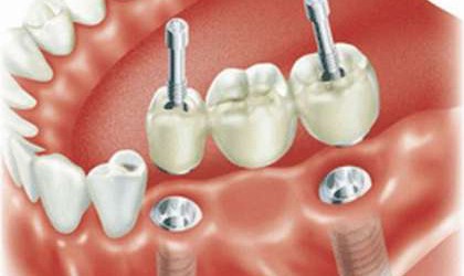 Ортопедический стоматологический приём - Стоматологическая клиника "Дента-проф" р.п. Шаля